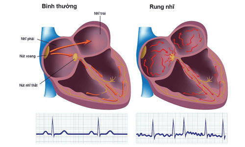 
Đột quỵ não và bệnh rung nhĩ có mối liên hệ mật thiết với nhau
