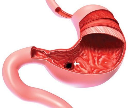 What is superficial gastric ulcer? Causes and symptoms