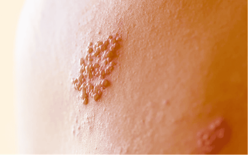 How long does shingles take to heal?