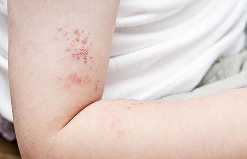 Does shingles leave a scar after it heals?