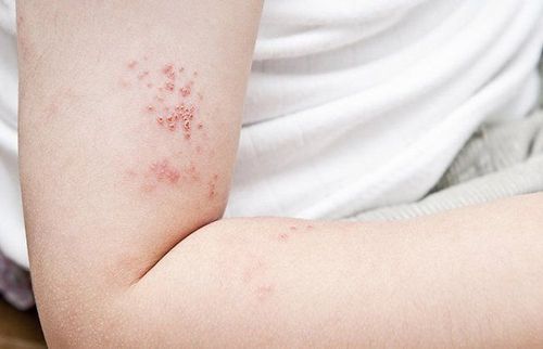 
Zona do virus thủy đậu gây ra, đây là một bệnh truyền nhiễm
