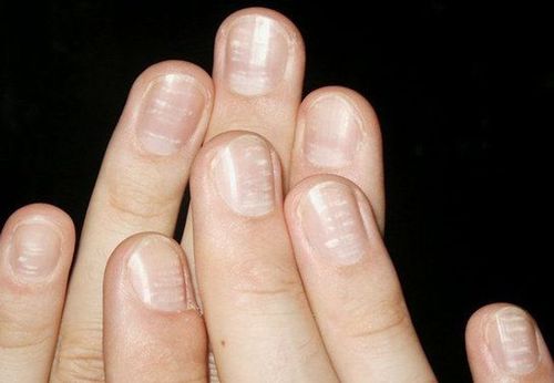 Learn about nail psoriasis