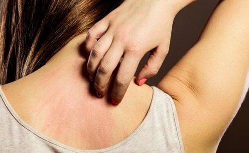 Droplet psoriasis: What you need to know