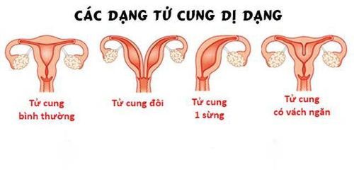 Các dị dạng tử cung có thể ảnh hưởng đến khả năng sinh sản