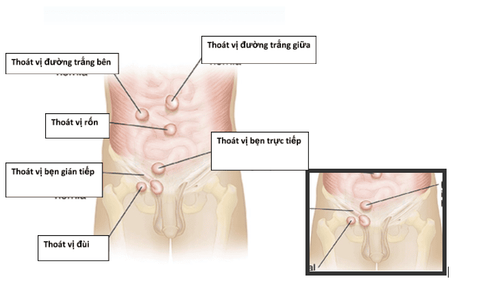 Inguinal hernia (Hernia): Frequently asked questions