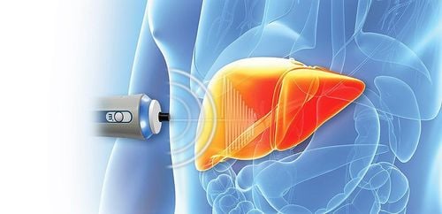 Fibroscan ultrasound determines the elasticity of liver tissue