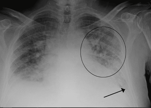 Acute pulmonary edema: Diagnosis and treatment