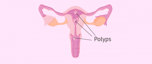 Can I get pregnant with uterine polyps?