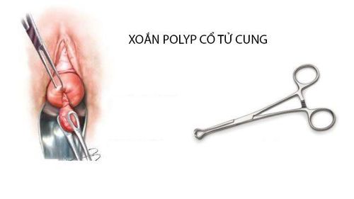 
Thủ thuật xoắn polyp cổ tử cung
