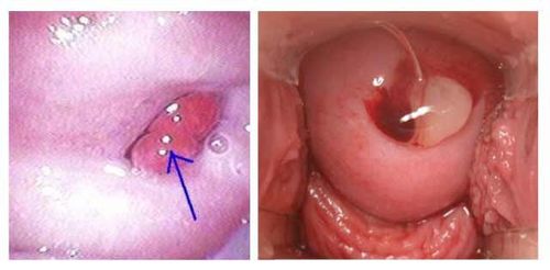 
Polyp nội mạc tử cung
