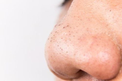 The formation and how to care for skin with blackheads