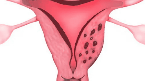 Types and stages of endometriosis