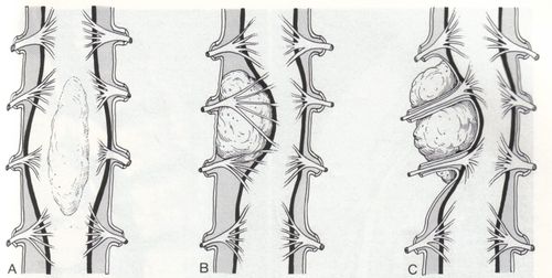 Extramedullary primary spinal cord tumor