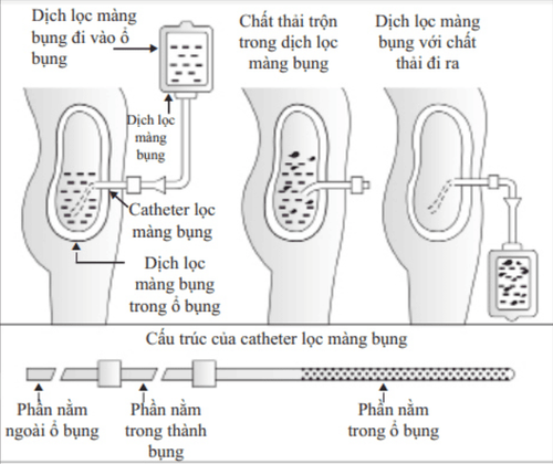 
Phương pháp lọc màng bụng
