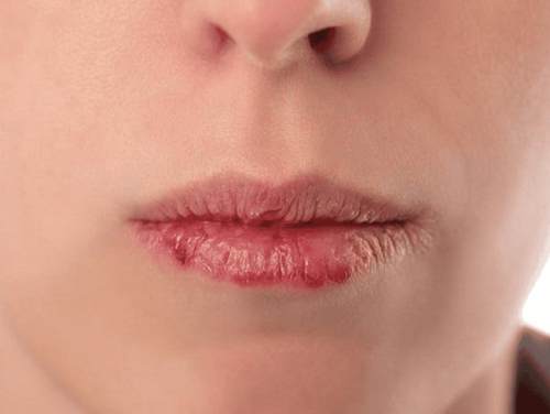 Why do you have atopic cheilitis?