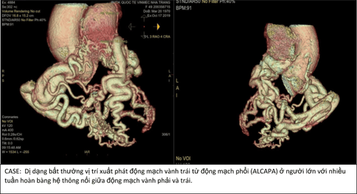 Early detection of coronary heart disease to prevent myocardial infarction