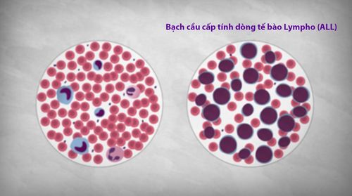 Acute Lymphocytic Leukemia (ALL) in Adults: Signs, Symptoms