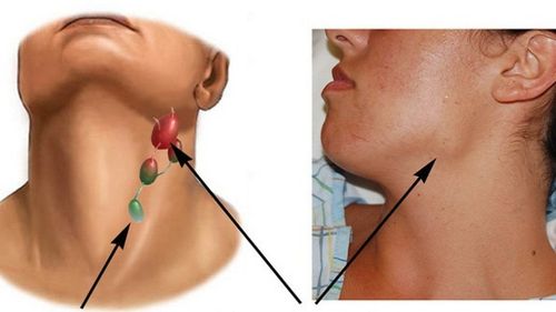 Diagnosis and treatment of Hodgkin lymphoma