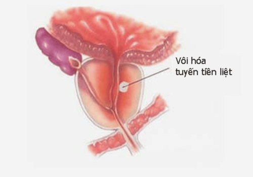 How does prostate calcification form and is it dangerous?