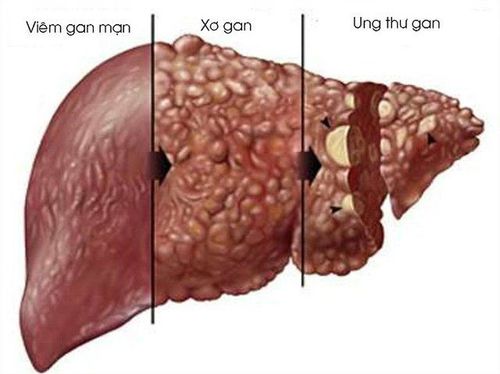 
Quá trình viêm gan mạn tính có thể gây ra vôi hóa gan
