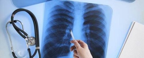 Is Lung Calcification Dangerous?