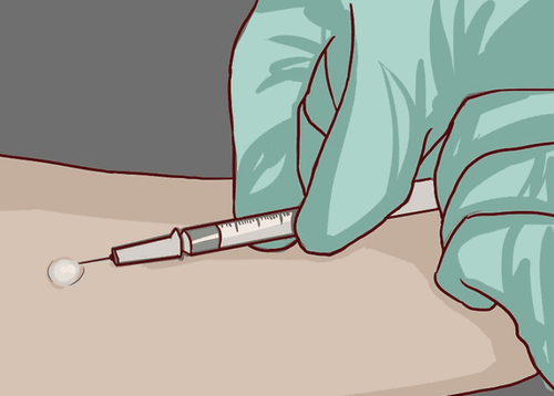 Tuberculosis test for subcutaneous injection