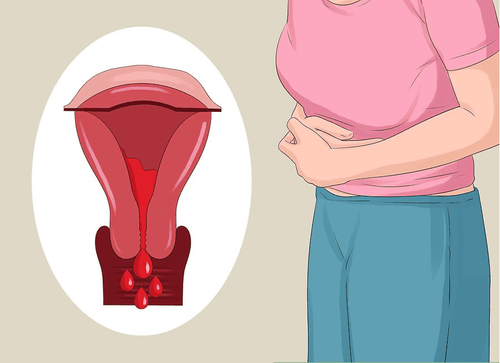 Risk factors for endometriosis