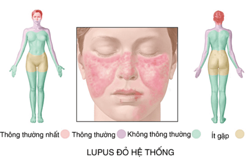 
Bệnh lý Lupus ban đỏ hệ thống có thể gây triệu chứng đau đầu cho người bệnh
