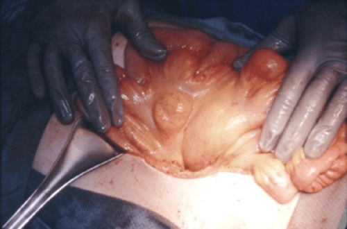 Laparoscopic resection of mesenteric tumor