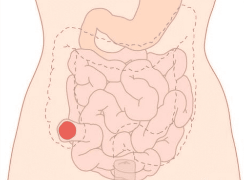 When can the colostomy be closed after peritoneal TB surgery?