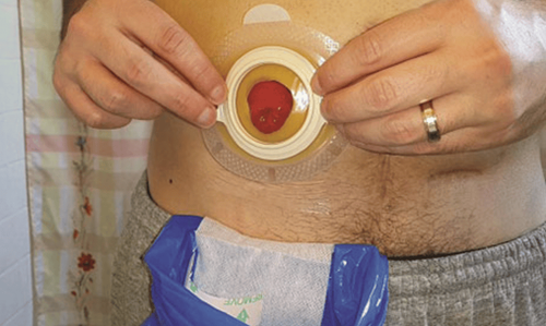 Can colostomy be removed using colostomy?