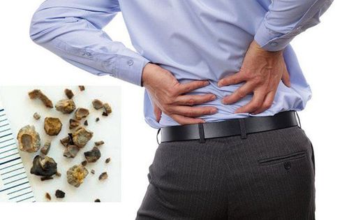 Learn 6 methods to diagnose kidney stones