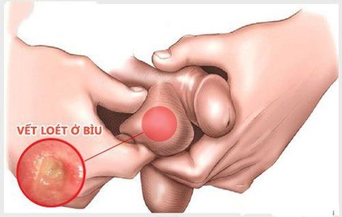 
Hình ảnh bệnh Behcet ở nam giới
