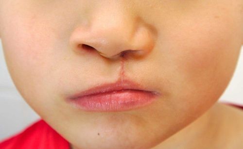 Instructions for taking care of children with cleft lip and palate