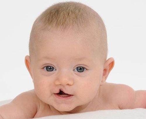 Cleft lip and palate in children: Why shouldn't surgery be done too soon?