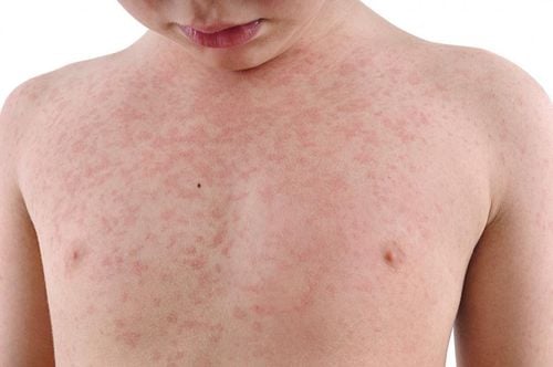 Caring for children with heat rash caused by heat in