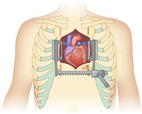 
Áp dụng phương pháp mổ hở khi thực hiện cấy thiết bị hỗ trợ thất trái (LAVD)
