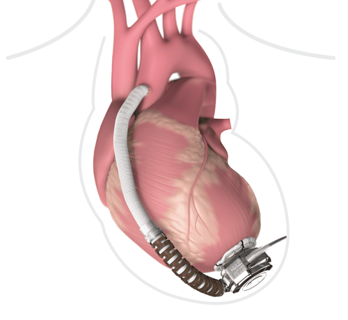 Cost of implanting left ventricular assist device (LAVD) for people with heart failure