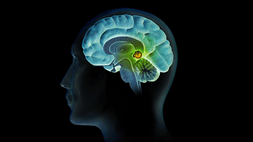 Learn about pineal gland tumors