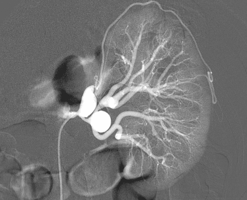 Digital image erasing background and node malformation of renal vessels