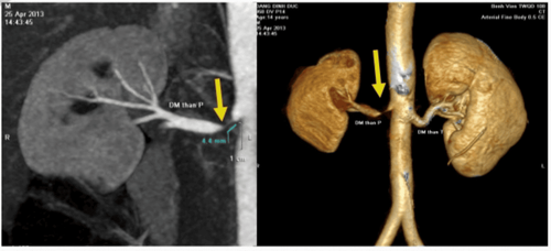 Types of renal artery stenosis