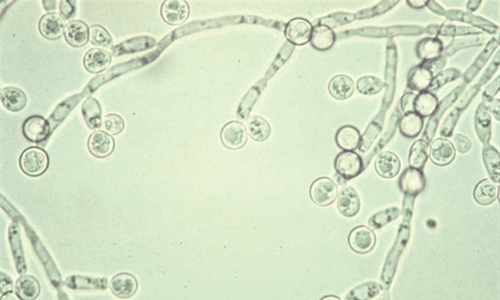 Bệnh niêm mạc do candida: Nguyên nhân, chẩn đoán và điều trị