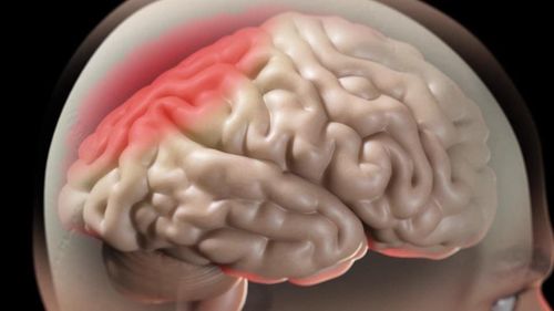 Management of cerebral edema in acute ischemic stroke