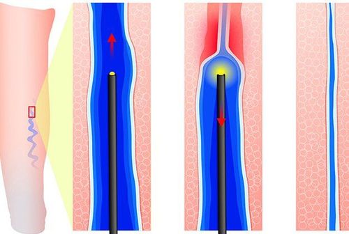 
Sử dụng laser điều trị suy giãn tĩnh mạch chi dưới
