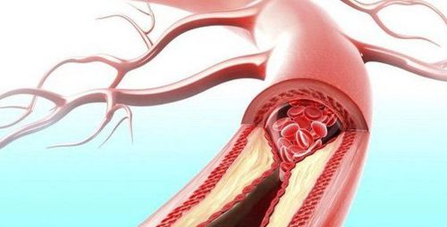 Diagnosis and treatment of chronic iliac aortic occlusion