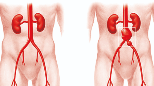 Digital image erasing the background of the abdominal aorta