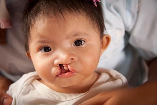 When is the best time to have cleft palate surgery for children?