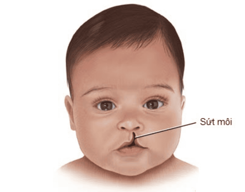 Common cleft palate locations in children