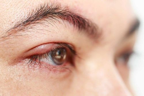 How is blepharitis treated?