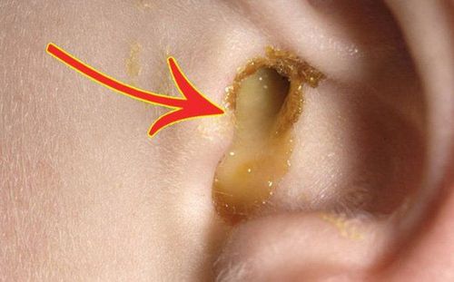 What should I do when taking medicine to treat otitis media?